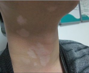 白癜风图片 白癜风症状图片